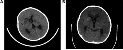 Paroxysmal sympathetic hyperactivity syndrome caused by Streptococcus intermedius meningoencephalitis in children: a case report and literature review